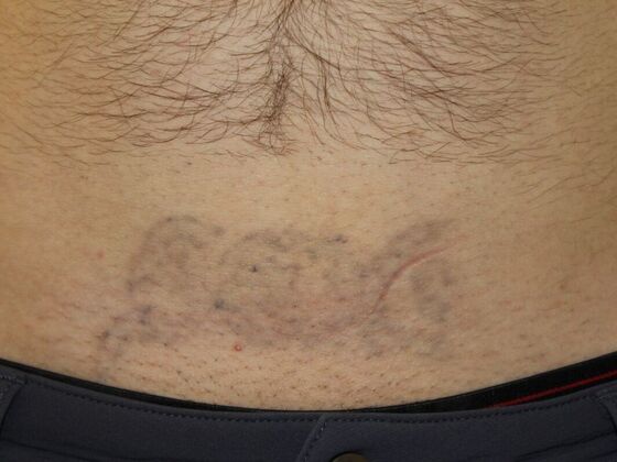 Laser Tattoo Removal Case 38 - After