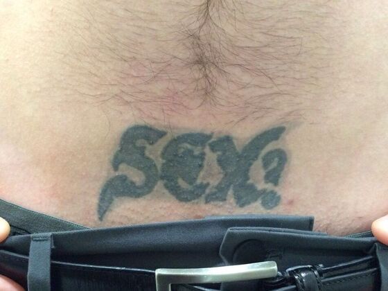 Laser Tattoo Removal Case 38 - Before