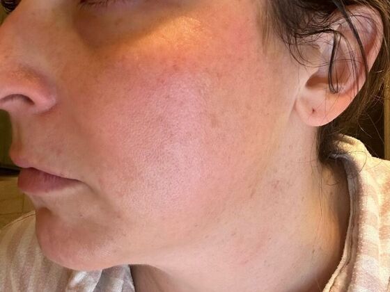 Skin Treatments Case 12 - After