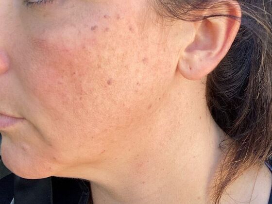 Skin Treatments Case 12 - Before