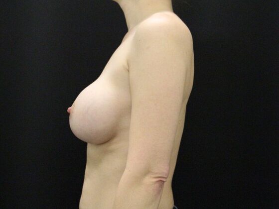 Breast Augmentation: Case 19 - After
