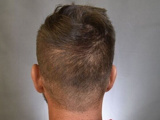 FUE Scars: Case 1 - After