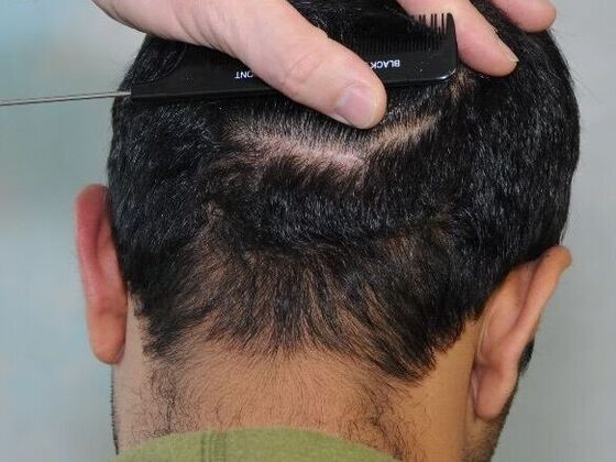 FUT Scars: Case 18 - After