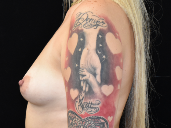 Breast Augmentation: Case 4 - Before