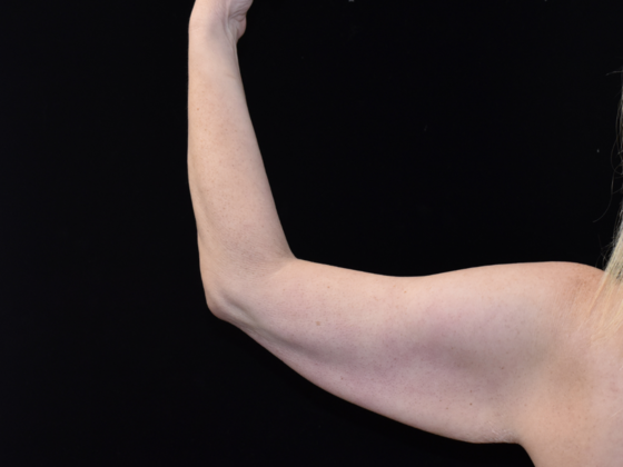 Brachioplasty: Case 3 - Before- back