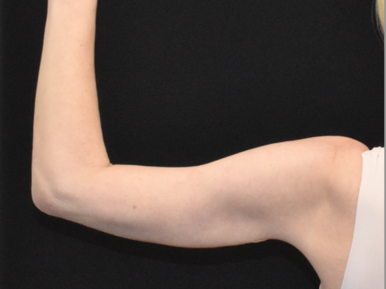 Brachioplasty: Case 3 - After- back