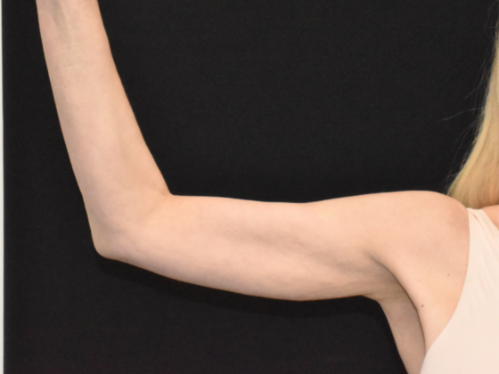 Brachioplasty Case 3 - After