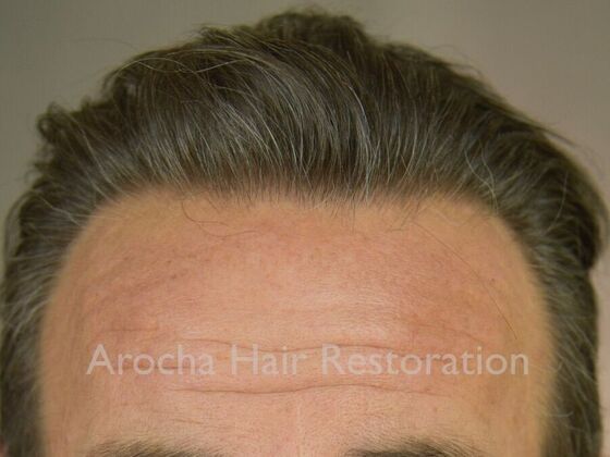 FUT Hair Restoration Case 36 - After