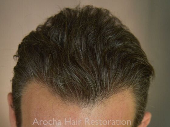 FUT Hair Restoration: Case 36 - After