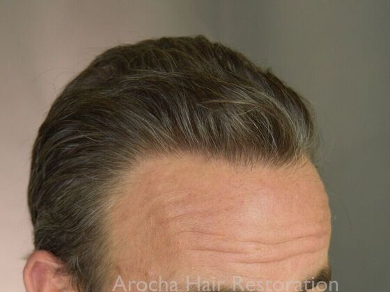 FUT Hair Restoration: Case 36 - After