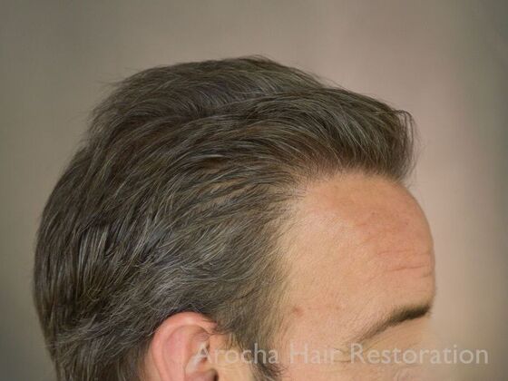 FUT Hair Restoration: Case 36 - After