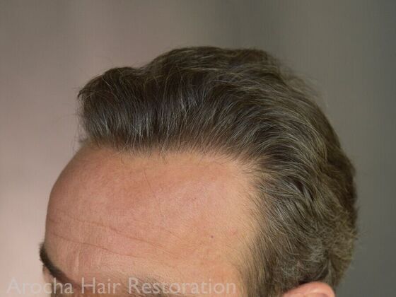 FUT Hair Restoration: Case 36 - After
