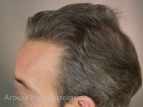 FUT Hair Restoration: Case 36 - After