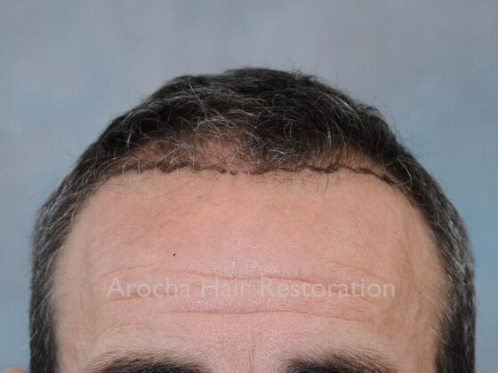 FUT Hair Restoration Case 36 - Before