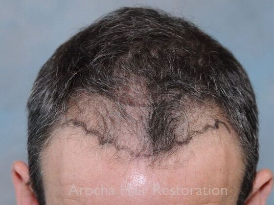 FUT Hair Restoration: Case 36 - Before