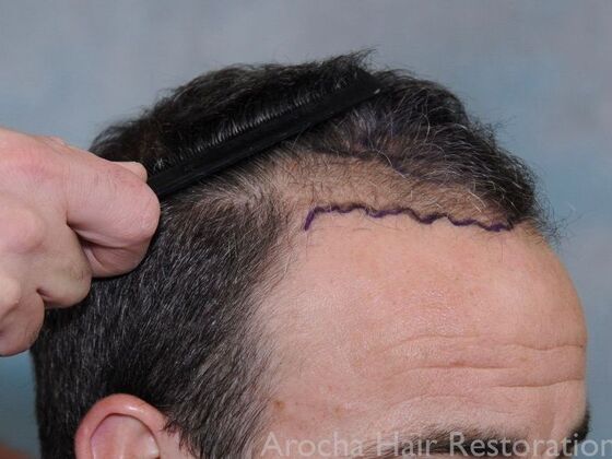 FUT Hair Restoration: Case 36 - Before