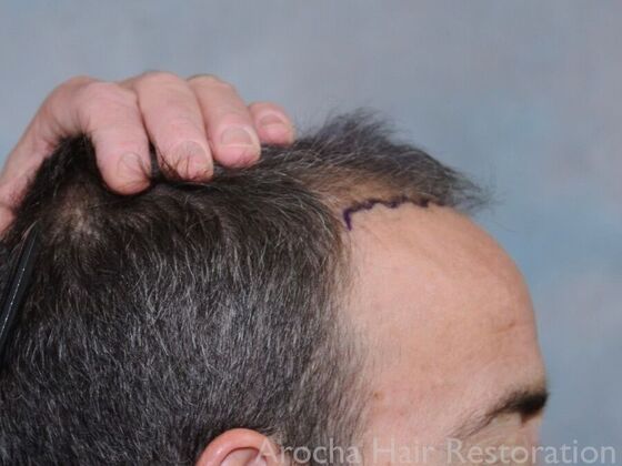 FUT Hair Restoration: Case 36 - Before