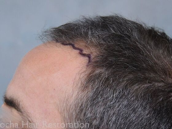 FUT Hair Restoration: Case 36 - Before