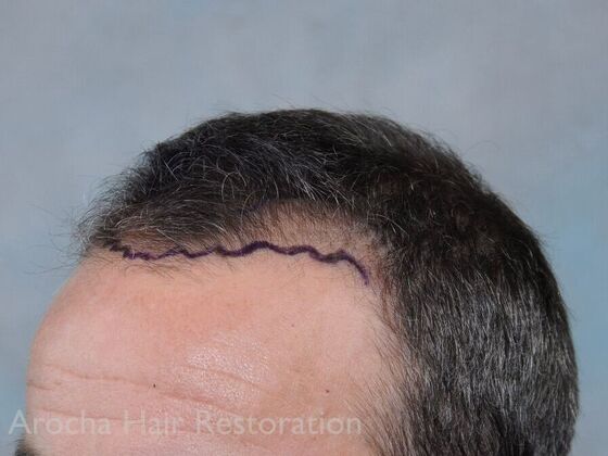 FUT Hair Restoration: Case 36 - Before