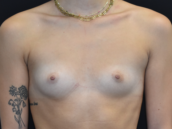 Breast Augmentation: Case 5 - Before