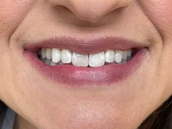 Porcelain Veneers: Case 37 - Before