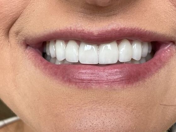 Porcelain Veneers: Case 37 - After