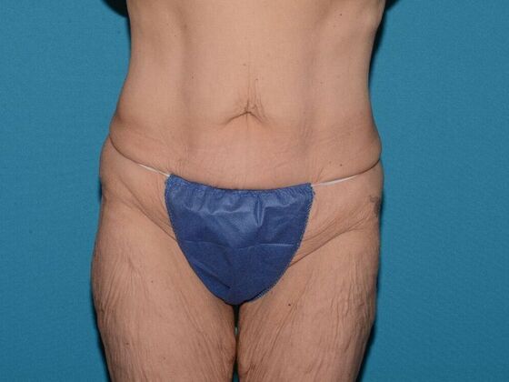 Torsoplasty Case 2 - Carmel - Before