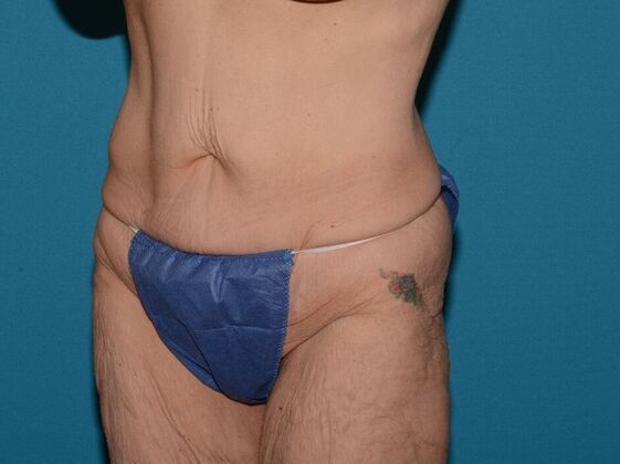 Torsoplasty: Case 2 - Carmel - Before