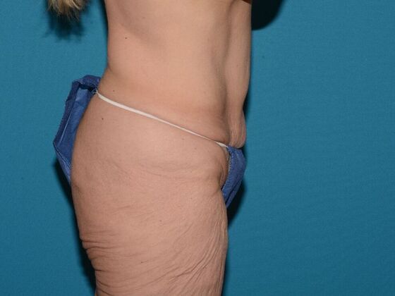 Torsoplasty: Case 2 - Carmel - Before