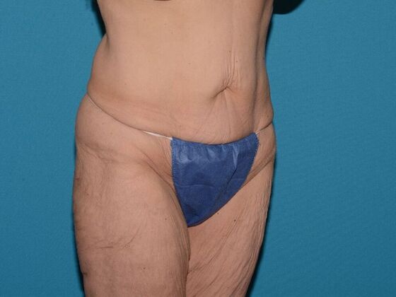 Torsoplasty: Case 2 - Carmel - Before