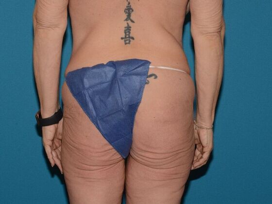 Torsoplasty: Case 2 - Carmel - Before