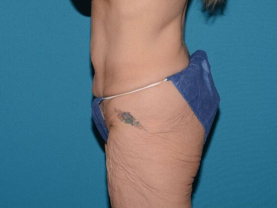 Torsoplasty: Case 2 - Carmel - Before