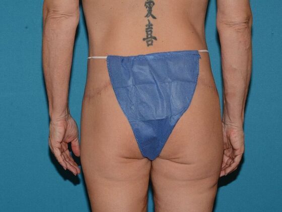 Torsoplasty: Case 2 - Carmel - After