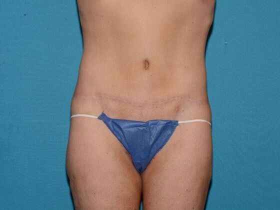 Torsoplasty Case 2 - Carmel - After