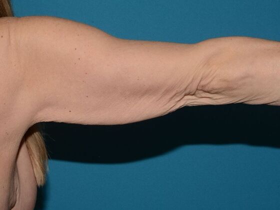 Arm Lift: Case 2 - Carmel - Before