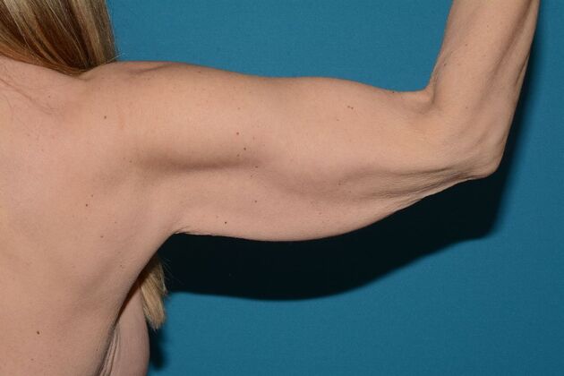 Arm Lift: Case 2 - Carmel - Before