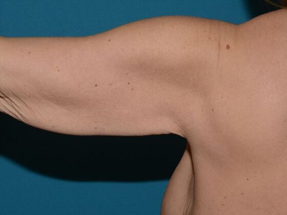 Arm Lift: Case 2 - Carmel - Before