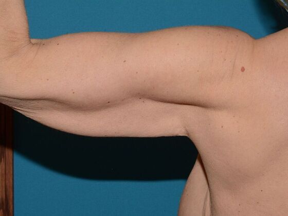 Arm Lift: Case 2 - Carmel - Before