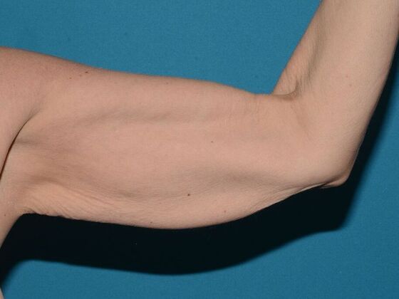 Arm Lift: Case 2 - Carmel - Before