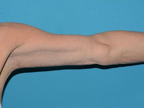 Arm Lift: Case 2 - Carmel - After