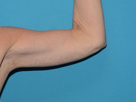 Arm Lift: Case 2 - Carmel - After