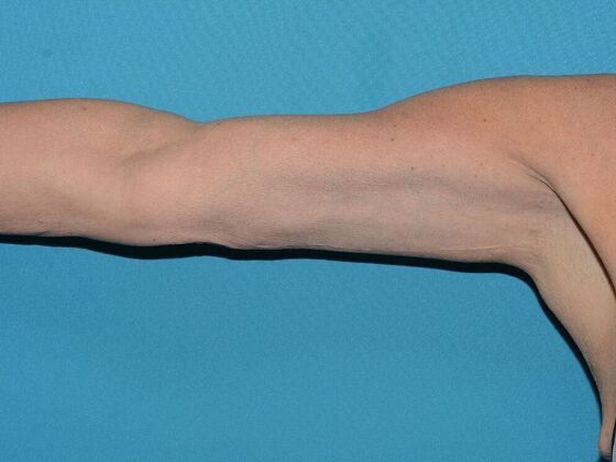 Arm Lift Case 2 - Carmel - After