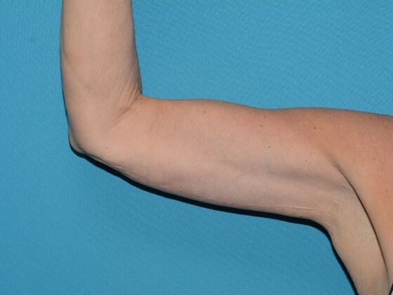 Arm Lift: Case 2 - Carmel - After