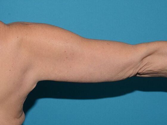 Arm Lift: Case 2 - Carmel - After