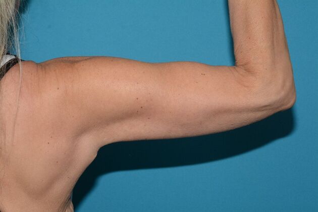 Arm Lift: Case 2 - Carmel - After