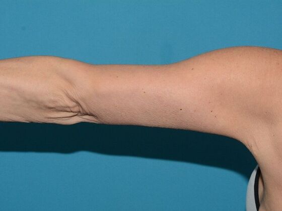 Arm Lift: Case 2 - Carmel - After