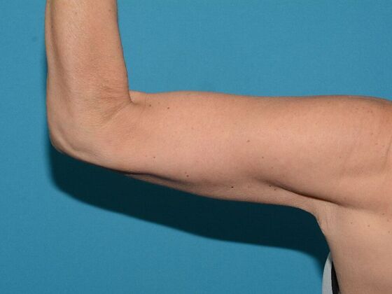 Arm Lift: Case 2 - Carmel - After