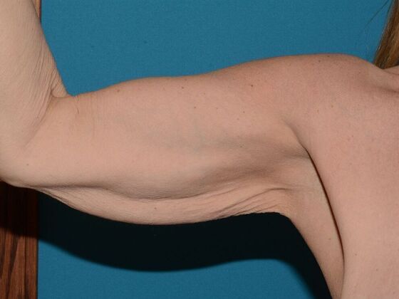 Arm Lift: Case 2 - Carmel - Before