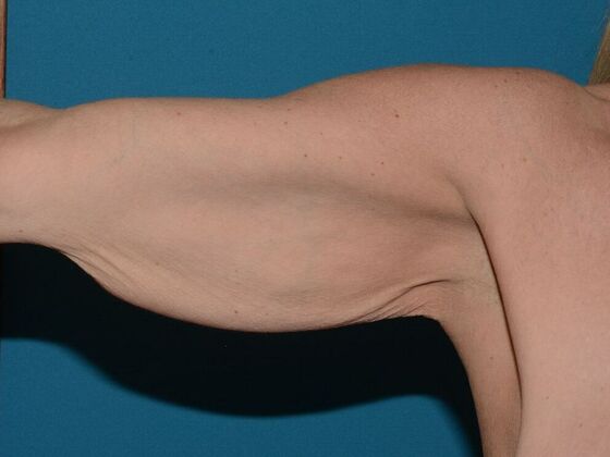 Arm Lift Case 2 - Carmel - Before