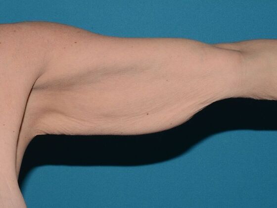 Arm Lift: Case 2 - Carmel - Before